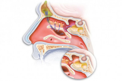LASER works in ENT Surgery