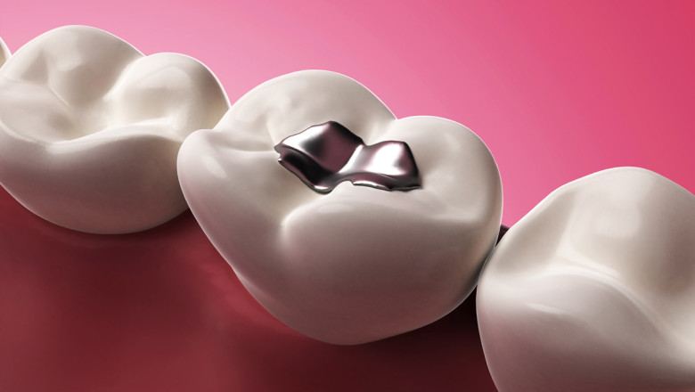 Dental Composite Fillings