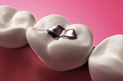 Dental Composite Fillings