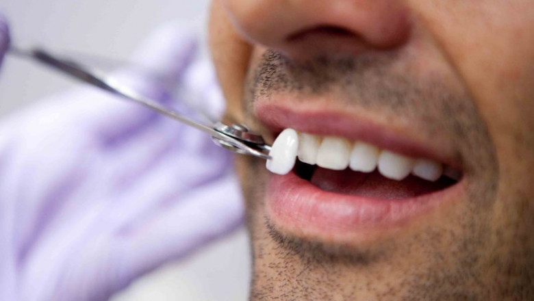 Know The 5 Main Benefits of Dental Veneers