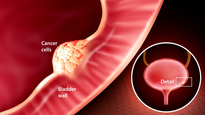 Bladder Cancer Market Share, Industry Leaders, Growing Demand, Opportunities, Competition, Key Players Analysis 2027
