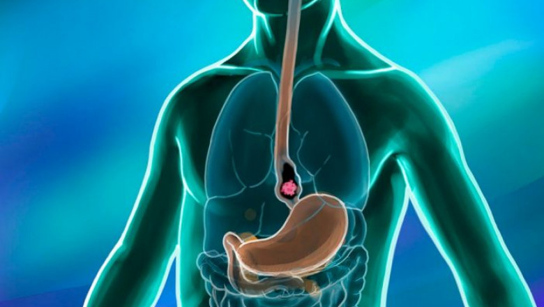 Esophageal Cancer Market Coronavirus (COVID-19) Impact Analysis with Business Opportunities, Survey And Growth Forecast 2027