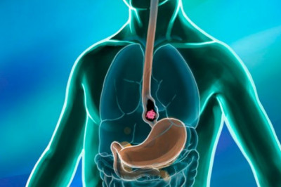 Esophageal Cancer Market Coronavirus (COVID-19) Impact Analysis with Business Opportunities, Survey And Growth Forecast 2027