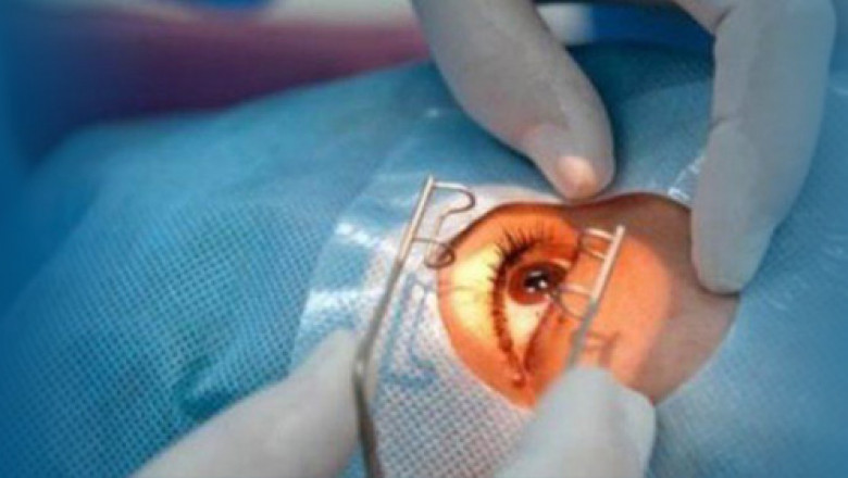 Ophthalmic Lasers Market Key Enhancement, with Status, Trends and Future Prospective to 2027