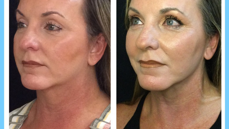 Most Desirable Facial cosmetic surgery