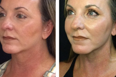 Most Desirable Facial cosmetic surgery