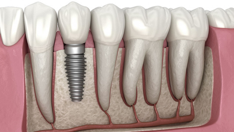 Things to Know About Dental Implants