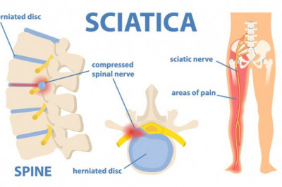 Pain from sciatica can be described in different ways, depending on the cause.