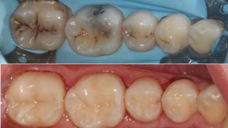 What is a Temporary Tooth Filling?