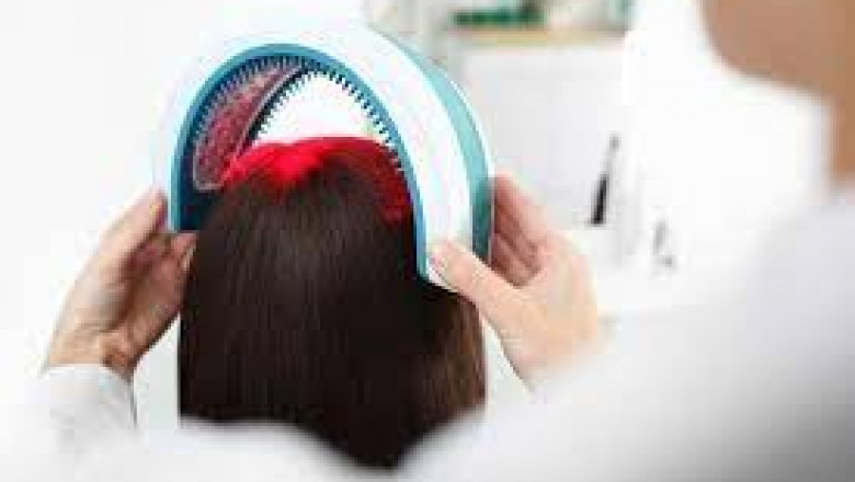 Laser Hair Loss Devices Market 2021 - Industry Analysis by Geographical Regions, Type and Application, Forecast to 2028