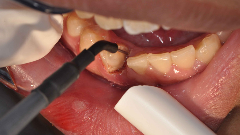 Electrosurgery units - how they work and how they should be used