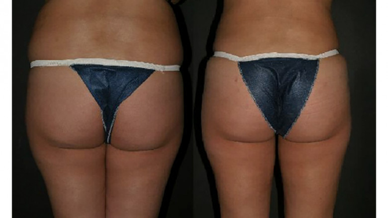 Get The Perfect Shaped Butts With BBL (Brazilian Butt Lift) Surgery: