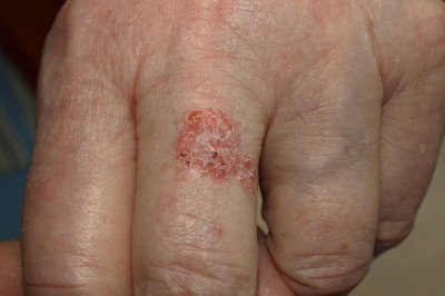 Bowen Disease Treatment: What You Need To Know