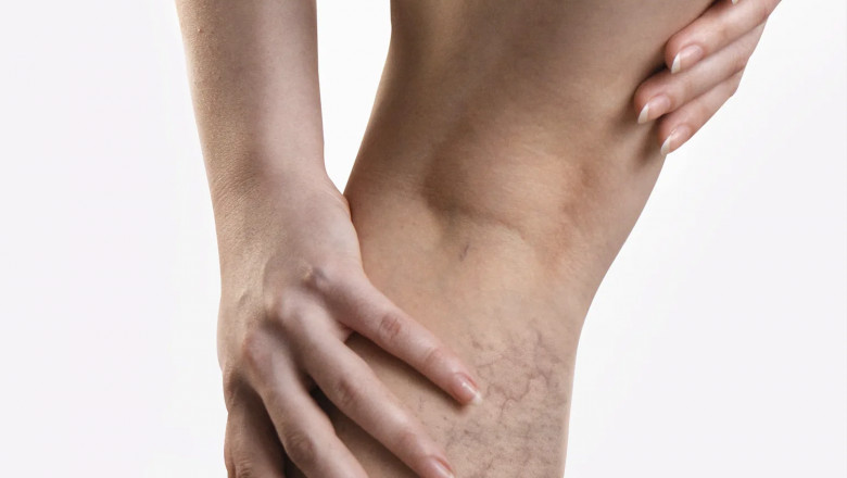 How To Deal With Spider Veins