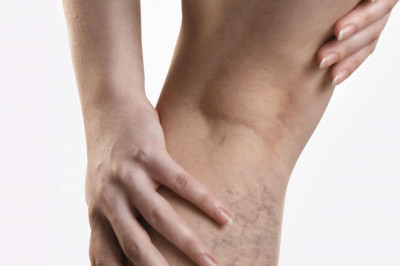 How To Deal With Spider Veins