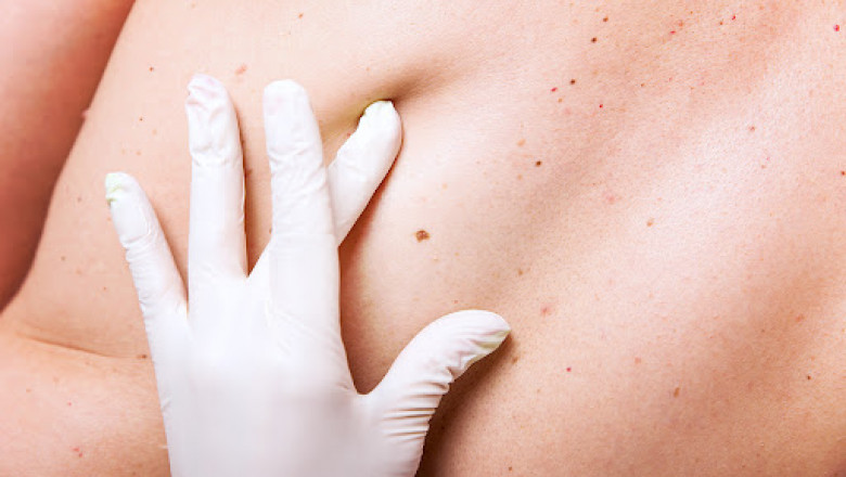 The Benefits of Mohs Surgery for Saving Skin Health