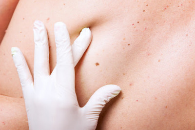 Mohs Surgery Venice | ReJUVA Dermatology