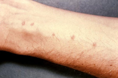 Schistosomiasis Disease Market 2021 Industry Outlook, Business Strategies and COVID-19 Impact Analysis 2028