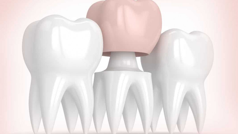 Tooth Crown: Is This Therapy for You?
