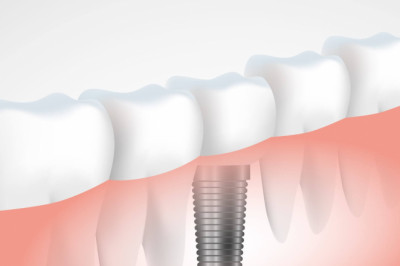 Dental Implants Costs - What You Required to Know?