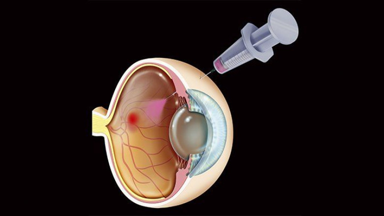 Diabetic Macular Edema Treatment Market : Global Industry Perspective, Comprehensive Analysis and Forecast 2021 to 2028