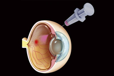 Diabetic Macular Edema Treatment Market : Global Industry Perspective, Comprehensive Analysis and Forecast 2021 to 2028