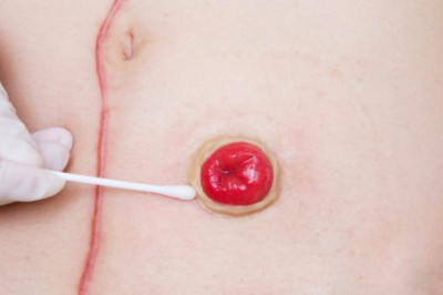 Stoma/Ostomy Care Market Impacts, CAGR, Growth Factors and Forecast From 2021 to 2028