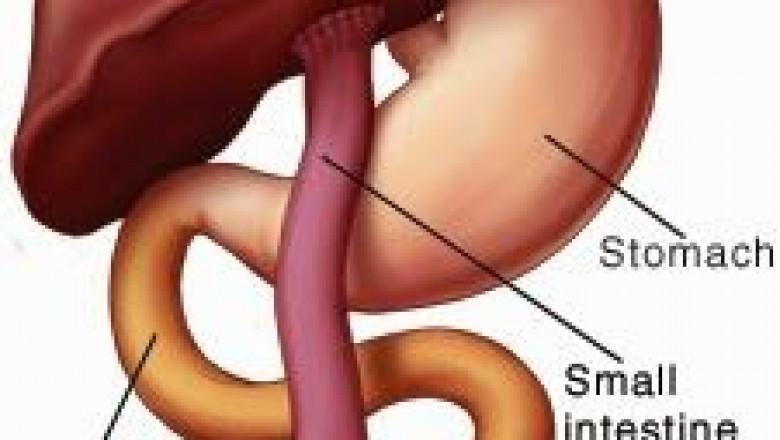 Global Biliary Atresia Treatment Market Research Report 2021-2028