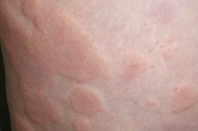 Hives treatment Market 2021 | Demand and Scope with Outlook, Business Strategies, Challenges and Forecasts to 2028