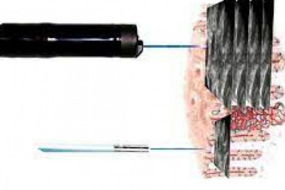 Laser Endomicroscopy Market 2021 Company Overview, Recent Developments and SWOT Analysis 2028