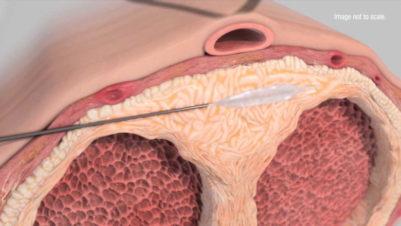 Peyronie's disease treatmen Market Impacts, CAGR, Growth Factors and Forecast From 2021 to 2028