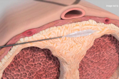 Peyronie's disease treatmen Market Impacts, CAGR, Growth Factors and Forecast From 2021 to 2028