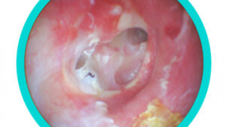 Ear Infection Treatment | Entconsultant.uk