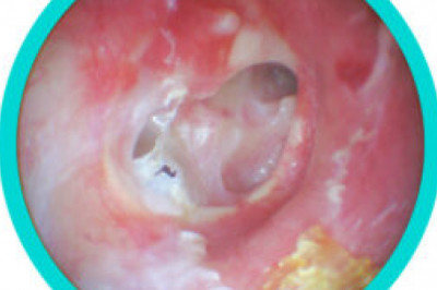 Ear Infection Treatment | Entconsultant.uk