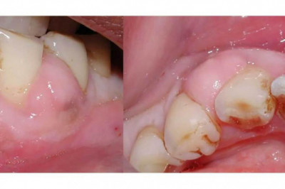 Everything  you need to know about veneer teeth