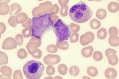 Myelodysplastic Syndrome Market 2021 Company Overview, Recent Developments and SWOT Analysis 2028