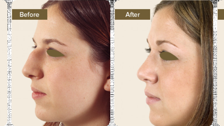 What is Rhinoplasty Treatment?