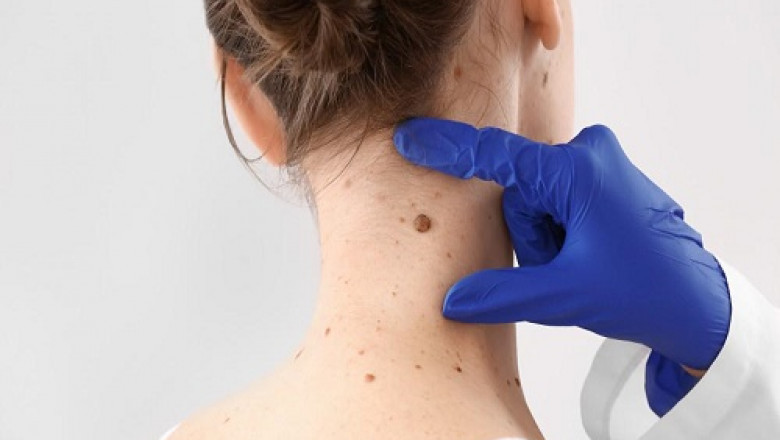 Consult A Dermatologist If You See A Suspicious Spot
