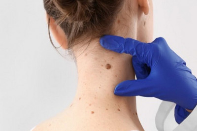 Consult A Dermatologist If You See A Suspicious Spot