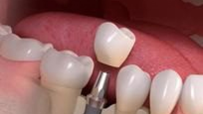 Dental Implants Service in Eatontown, New Jersey