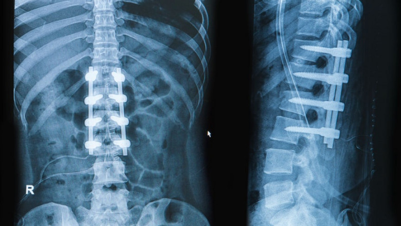 Spinal Machined Bone Allograft Market 2021 Growth, Share, Trend, Segmentation and Forecast to 2028