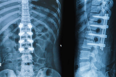 Spinal Machined Bone Allograft Market 2021 Growth, Share, Trend, Segmentation and Forecast to 2028