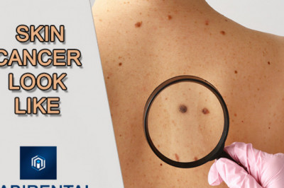 What Does Skin Cancer Look Like? - LabirentAI