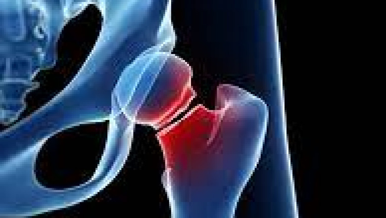 What is total hip replacement?