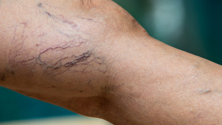 What Type of Doctor Will Treat My Vein Disease?