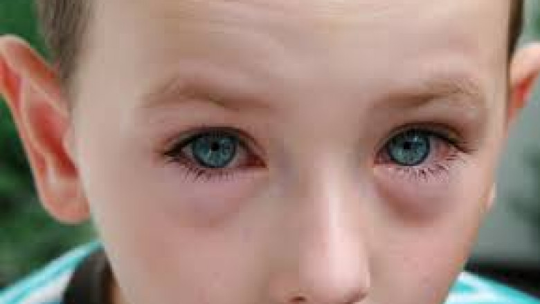 Allergic Conjunctivitis Market, Global Forecast Treated Patients By Countries, Disease Type, Pipeline Drugs, Company Analysis
