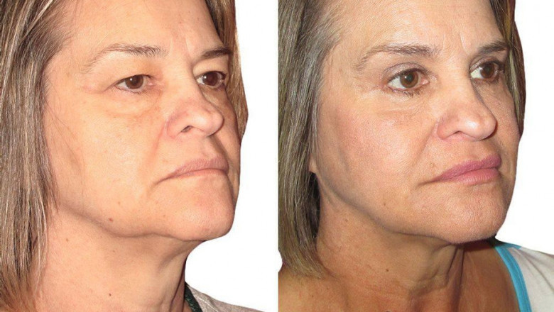How Eye Lift Surgery Can Help You Get Rid Of Ageing Signs?