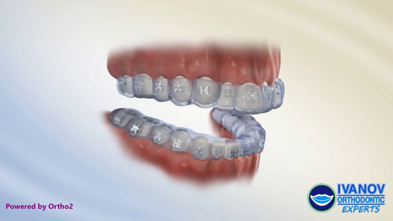 What Is The Thing You Should Do Before Getting Braces On?