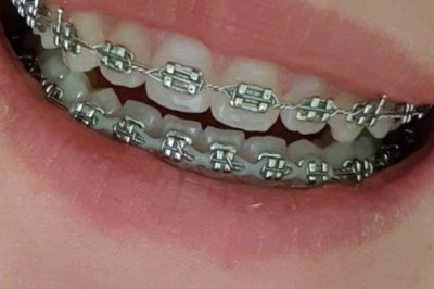 What Are Dental Braces Types?