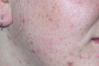 What Is Acne? Symptoms, Causes, Treatments